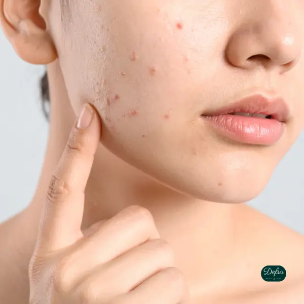 Rosmarin-Seife im Test Ideal für akneanfällige Haut v2